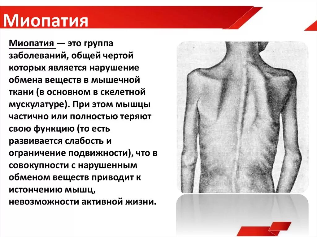 Миопатия что это за болезнь. Миопатический синдром, миопатия. Миопатия клинические проявления. Miapatiya.