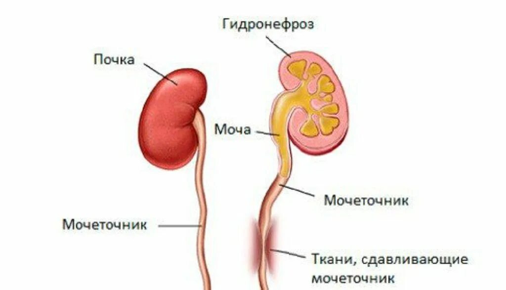 Перегиб мочеточника. Камень мочеточника с гидронефрозом. Гидронефроз почки схема. Сужение мочеточника гидронефроз. Гидронефроз со стриктурой мочеточника.