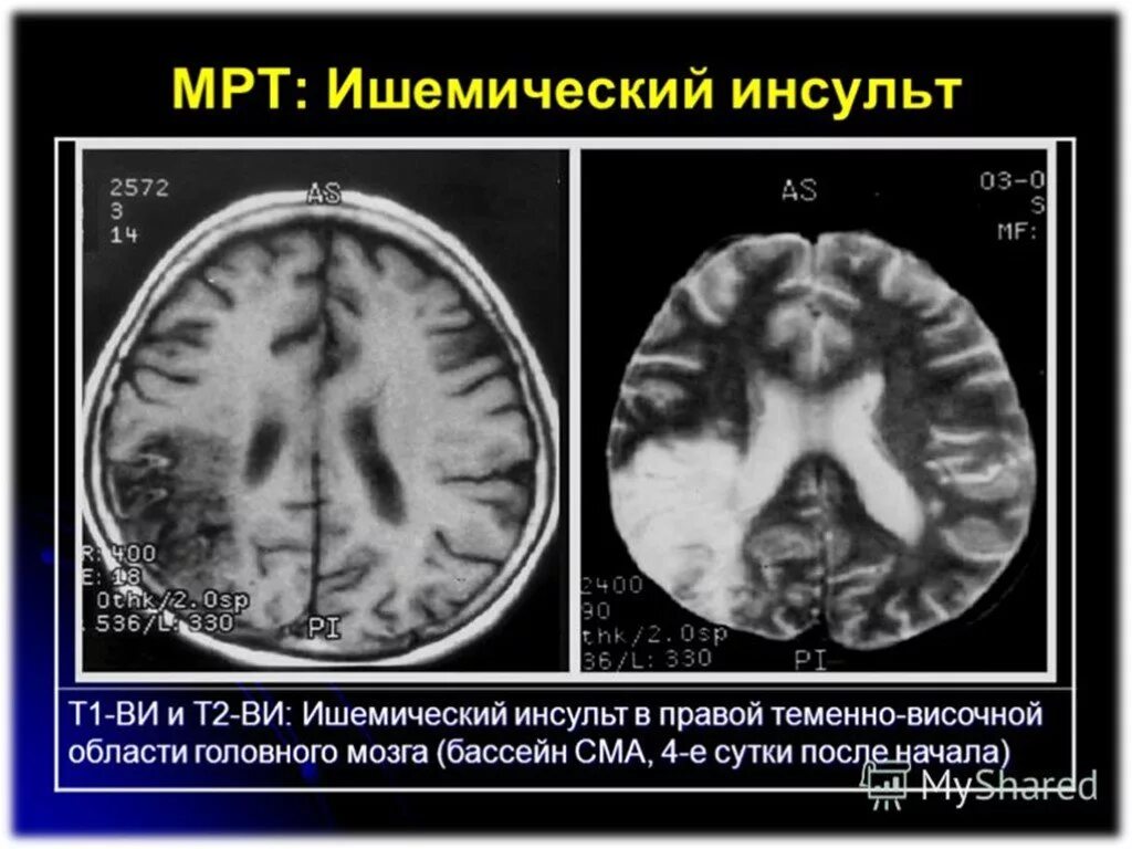 Ишемический инсульт снимок кт. Мрт снимки ишемического инсульта. Мрт ишемический инсульт т1. Ишемический инсульт мрт снимок. Ишемические изменения мозга