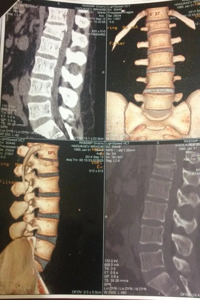 Компрессионный перелом th5 позвонка. Компрессионный перелом тела th12, l1, l2. Компрессионный перелом позвоночника l1 l2. Компрессионный перелом позвоночника th12 l2.