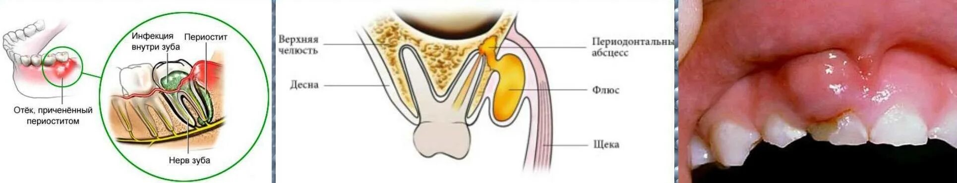 Опух рот чем полоскать. Периостит челюсти (флюс). Одонтогенный периостит челюсти.