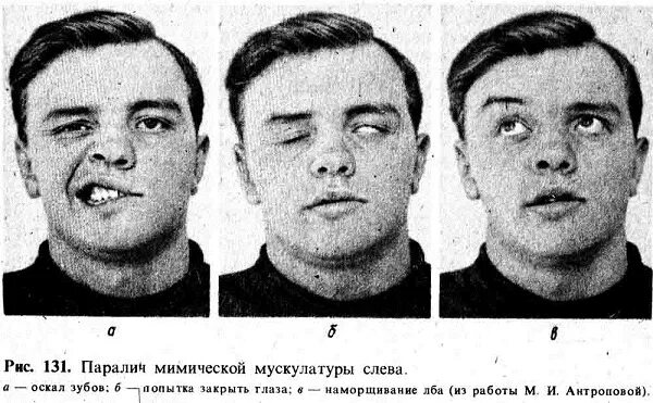 Лицевой неврит симптомы