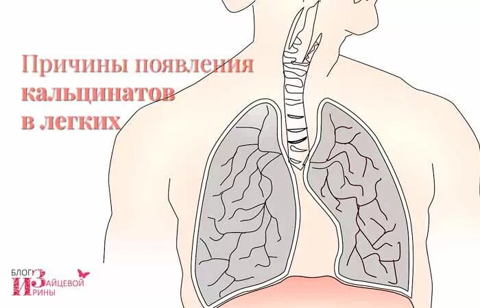 Кальцинат s3 правого легкого это. Остаточные изменения в легких. Кальцинаты туберкулез. Кальцинаты в легких рентген. Кальцинат s3 правого легкого это.