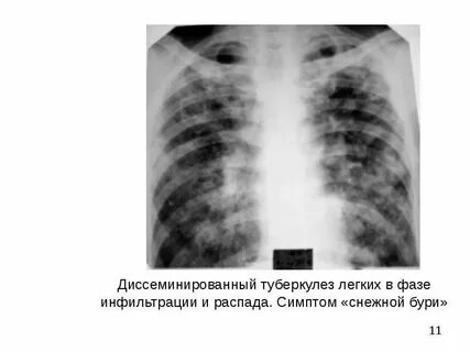 Диссеминированный кавернозный туберкулез