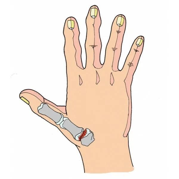Почему болят суставы больших пальцев. Ризартроз большого пальца левой руки. Ризартроз безымянного пальца. Артроз большого пальца руки. Основание большого пальца руки.