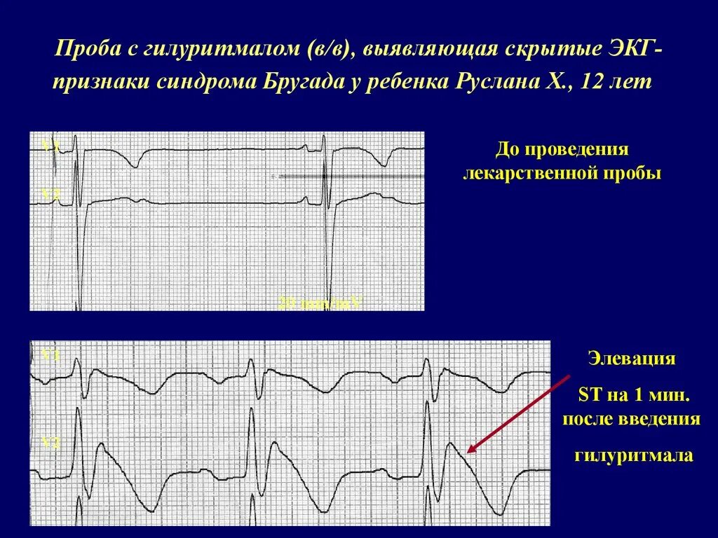 Бругада экг признаки. Синдром бругада экг критерии. Синдром бругада на экг 1 типа. Синдром бругада на экг 1 типа. Бругада экг признаки.