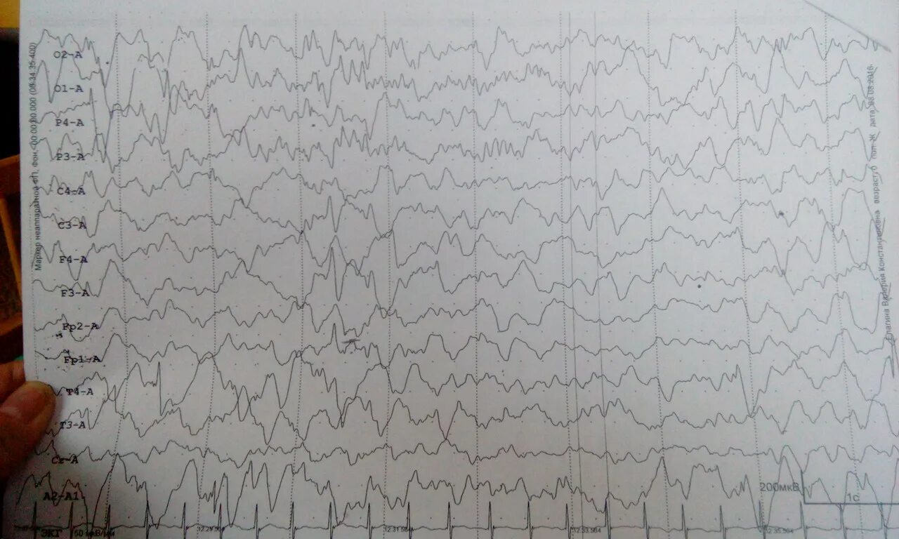 Ээг в нижнем новгороде. Эпиактивность на ЭЭГ. Эпи волна на ЭЭГ. Эпиактивность на ЭЭГ эпи. Эпиактивность на ЭЭГ У ребенка.