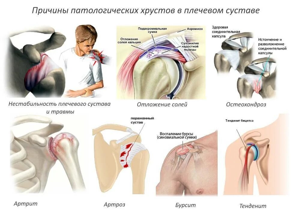 Болит плечо при поднятии. Плечевой сустав классификация. Нестабильность плечевого сустава. Хрустит плечевой сустав. Солевые отложения в плечевом суставе.