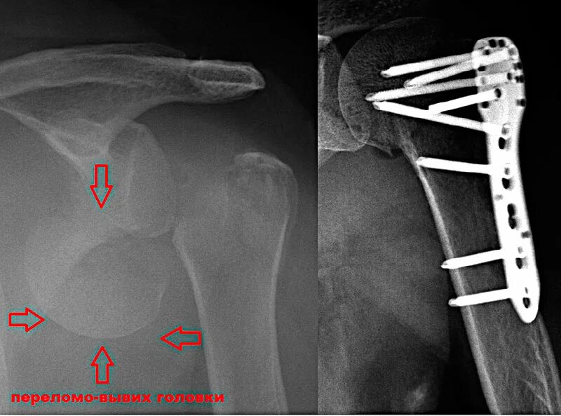 Остеосинтез перелома плечевой кости пластиной. Перелом хирургической шейки плеча остеосинтез. Рентген плечевого сустава перелом шейки плечевой кости. Остеосинтез шейки плеча рентген. Перелом плеча пластина