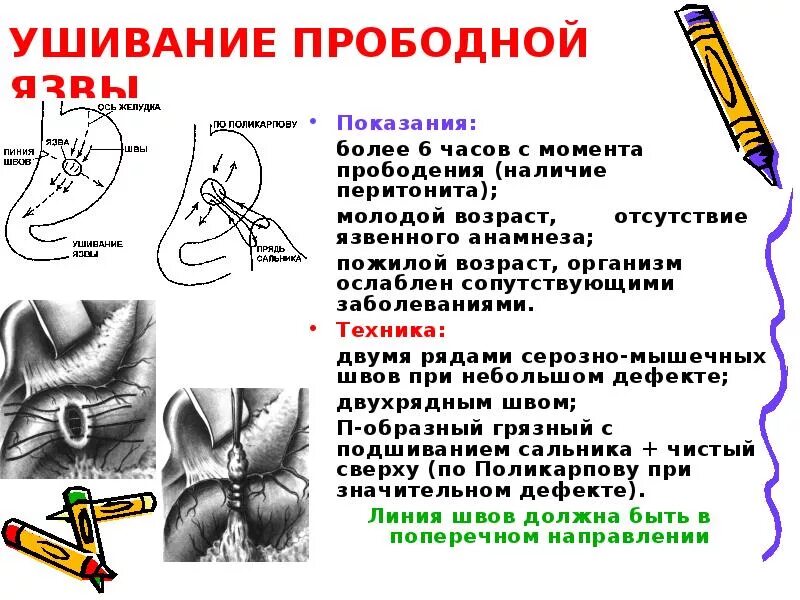 Язва операция сколько. Ушивание прободной язвы желудка. Операции при перфоративной язве желудка. Ушивание перфоративной язвы желудка по Оппелю Поликарпову. Обоснование ушивание перфоративной язвы желудка..