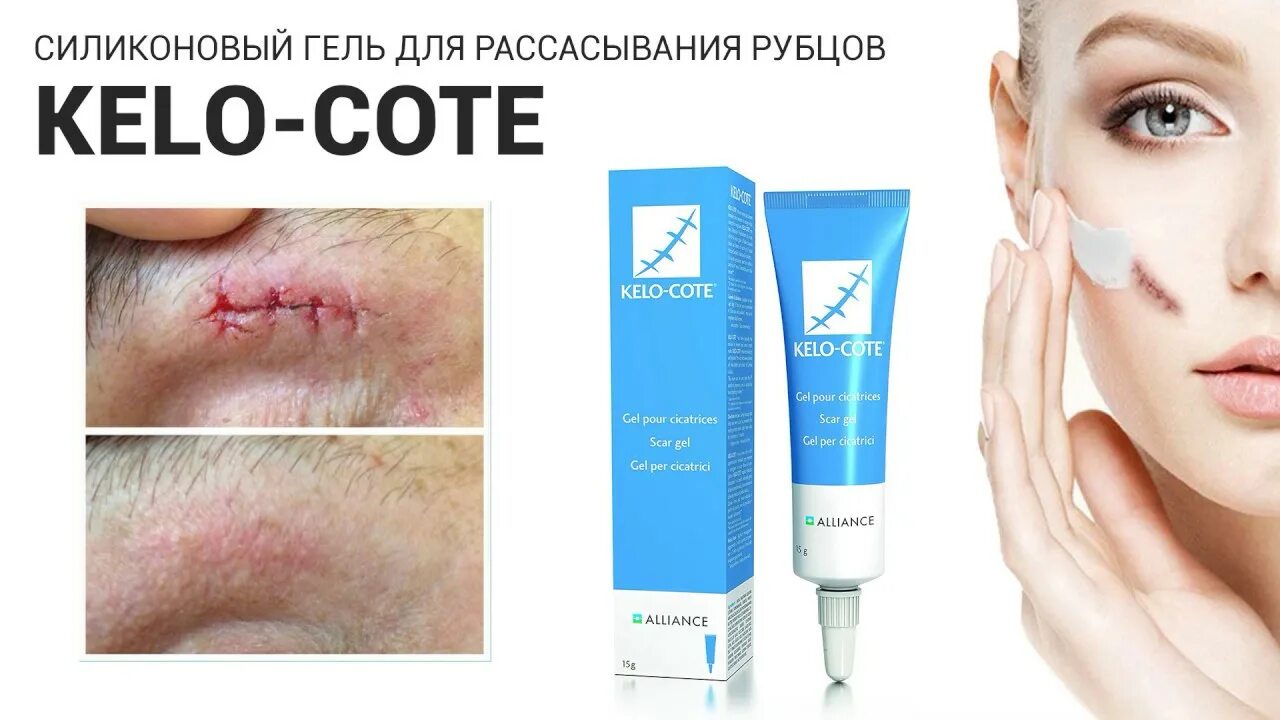 Пилинг тса при атрофических рубцах. Bioaqua removal of acne крем для лица. Лазерная наноперфорация постакне. Крем мазь от шрамов акне на лице. Печать радогона от шрамов.