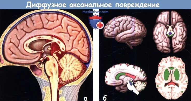 Диффузное аксональное повреждение. Диффузное аксональное повреждение кт. Аксональное повреждение иллюстрации. Диффузное аксональное повреждение мозга.