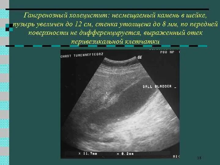 Изменение стенок желчного пузыря. Паравезикальной клетчатки желчного пузыря. УЗИ желчного пузыря острый холецистит. Гангренозный холецистит УЗИ. Перивезикальная клетчатка желчного.