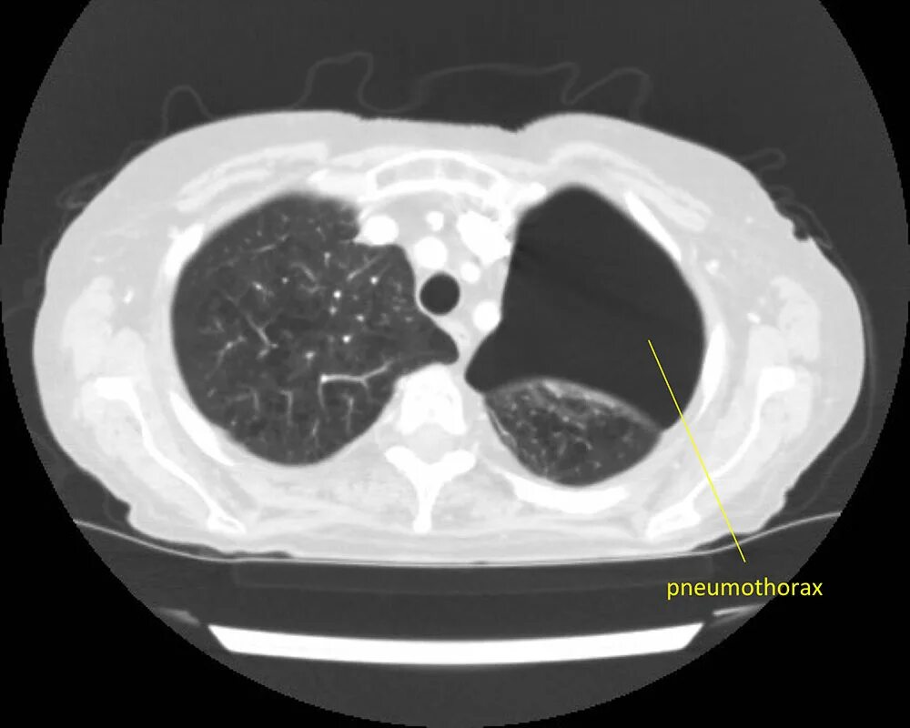 Дерева в почках в легких кт. Пневмоторакс на кт легких. Пневматоцеле легких на кт. Пневмоторакс легких кт исследование.