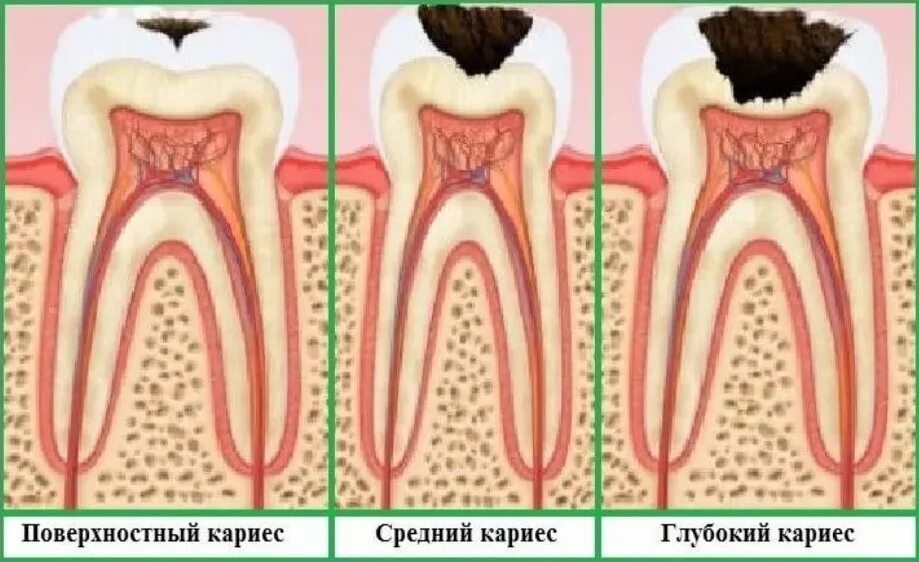 Кариас. Кариас. Фиссурный кариес пришеечный. Пришеечный кариес моляров. Поддесневой кариес корня.