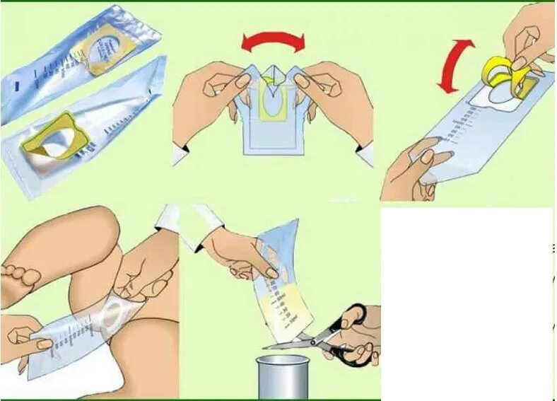 Не могу пописать первая помощь. Мочеприемник у новорожденных девочек для сбора. Как правильно приклеить мочеприемник девочке. Как правильно пользоваться мочеприемником для девочек новорожденных. Пакетик для сбора мочи у новорожденных мальчиков.