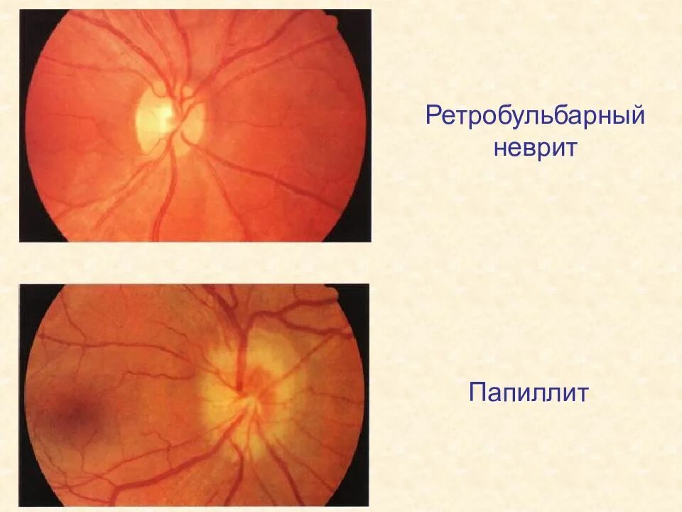 Тип зрительного нерва. Неврит зрительного нерва и ретробульбарный неврит. Ретробульбарный неврит зрительного нерва глазное дно. Оптический неврит папиллит. Папиллит диска зрительного нерва.