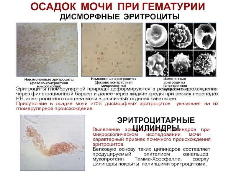 Осадок мочи. Осадки в моче. При макрогематурии в осадке мочи. Эритроциты в моче заболевание.