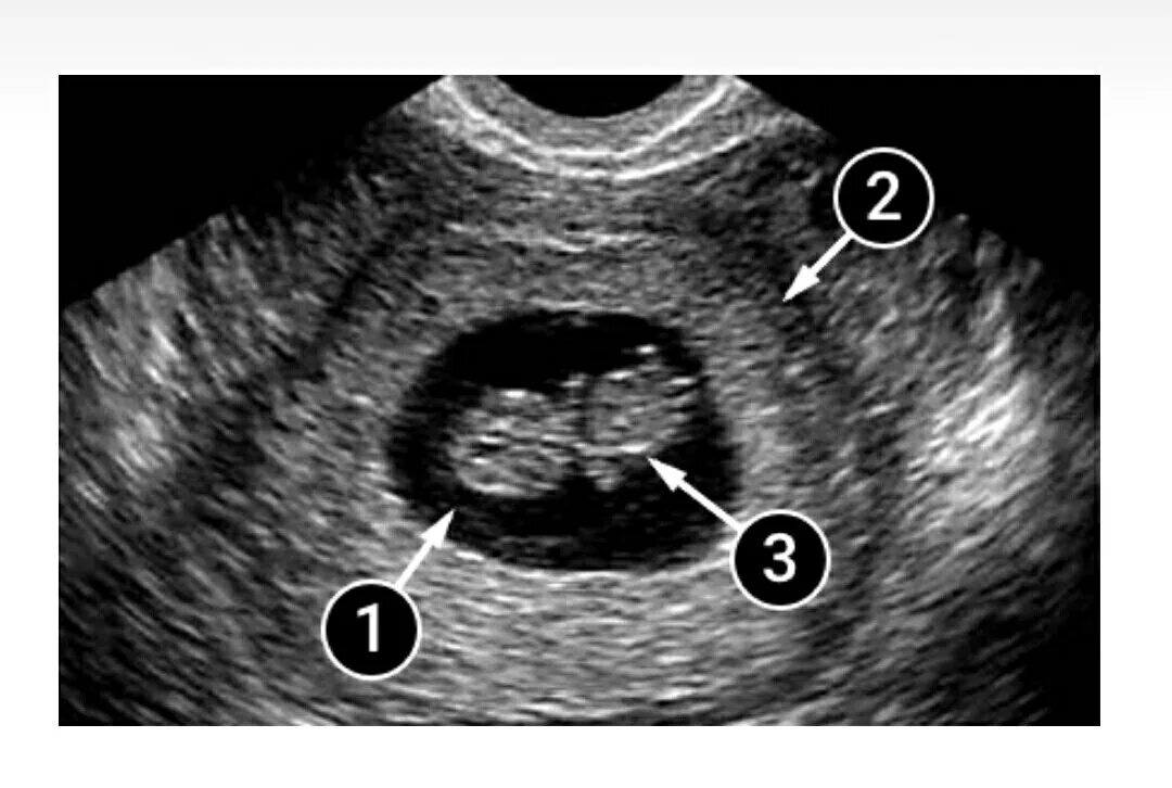 Как выглядит зародыш в 6 недель на УЗИ. УЗИ на 7 акушерской неделе беременности.