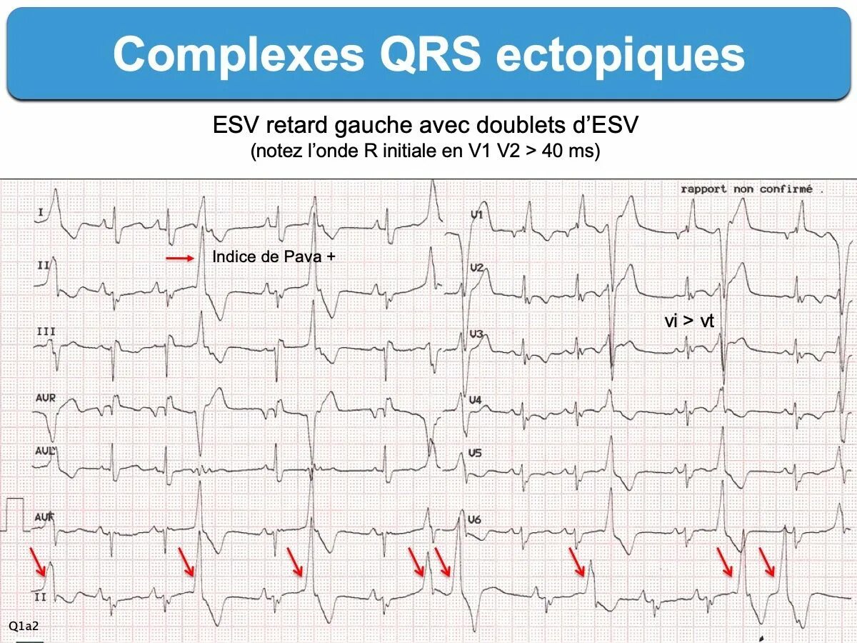 Qrs на экг что это. Расширение комплекса QRS на ЭКГ. Расширенный QRS на ЭКГ. Расширенный комплекс QRS на ЭКГ. Изменения комплекса QRS на ЭКГ.