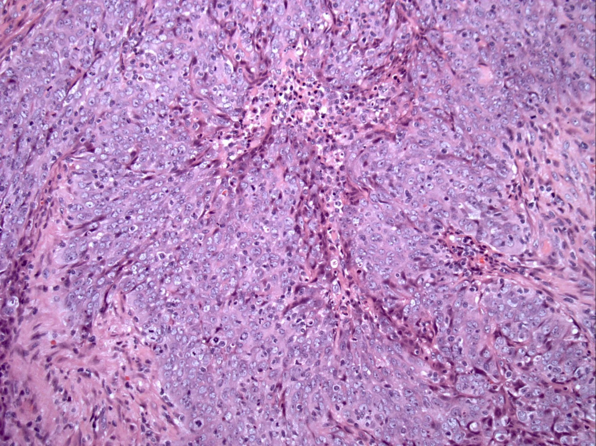 Lymphoepithelial carcinoma гистология. Nasopharyngeal squamous Cell carcinoma Pathology. Злокачественная опухоль из соединительной