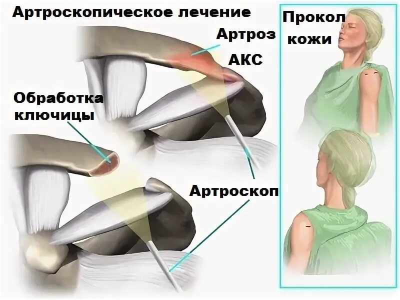 Лечение ключично акромиального артроза. Акромиально-ключичный сустав (акс). Артроз акромиального сочленения. Акромиально-ключичный артроз плечевого сустава 1 степени. Остеоартроз плечевого ключичного сустава.