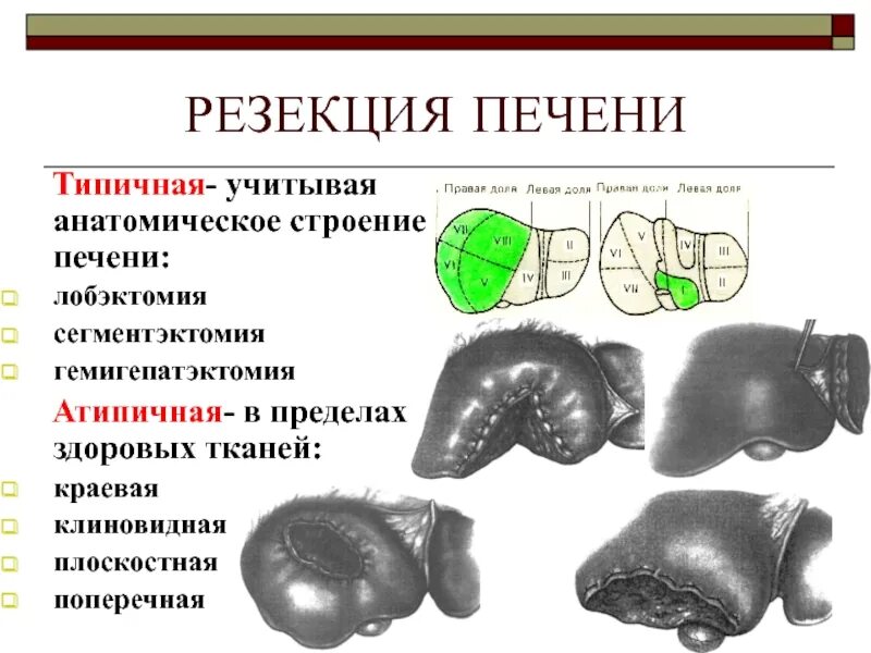 Операция по удалению печени. Атипическая резекция печени. Краевая резекция печени. Клиновидная резекция печени. Плоскостная резекция печени.