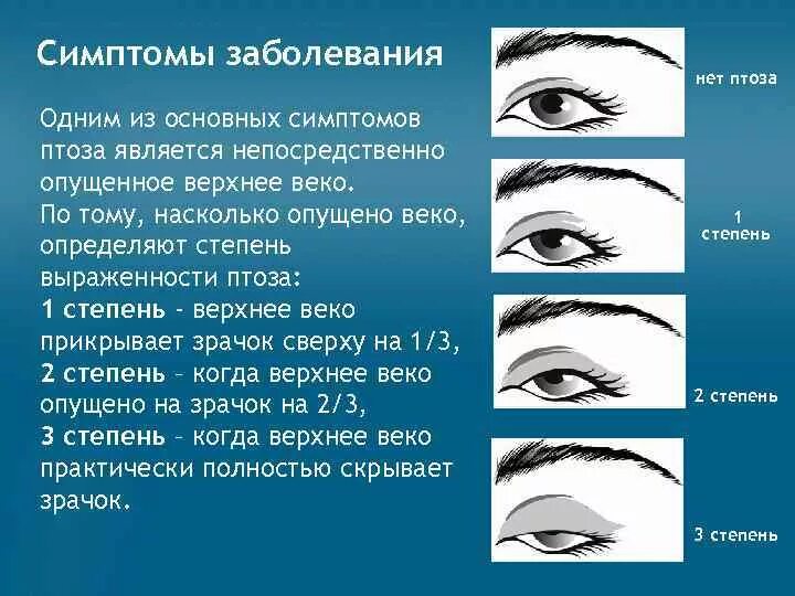 Вы плохо понимаете практический век. Птоз классификация по степеням. Степени опущения верхнего века. Степени птоза век. Птоз верхнего века классификация.