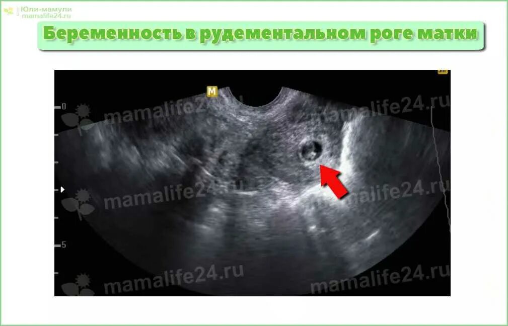 Внематочная беременность. Внематочная беременность после операции. Внематочная беременность операция. Внематочная беременность операция сроки