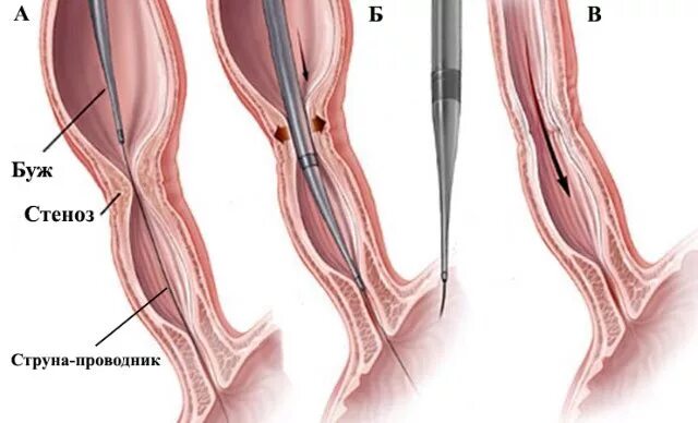 Сужение пищевода лечение. Ожоги пищевода бужирование. Хиатальное сужение в пищеводе. Экзогенное сужение пищевода.