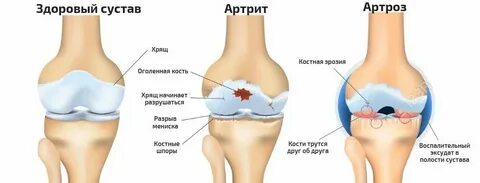 Ревматоидный артроз чем отличается