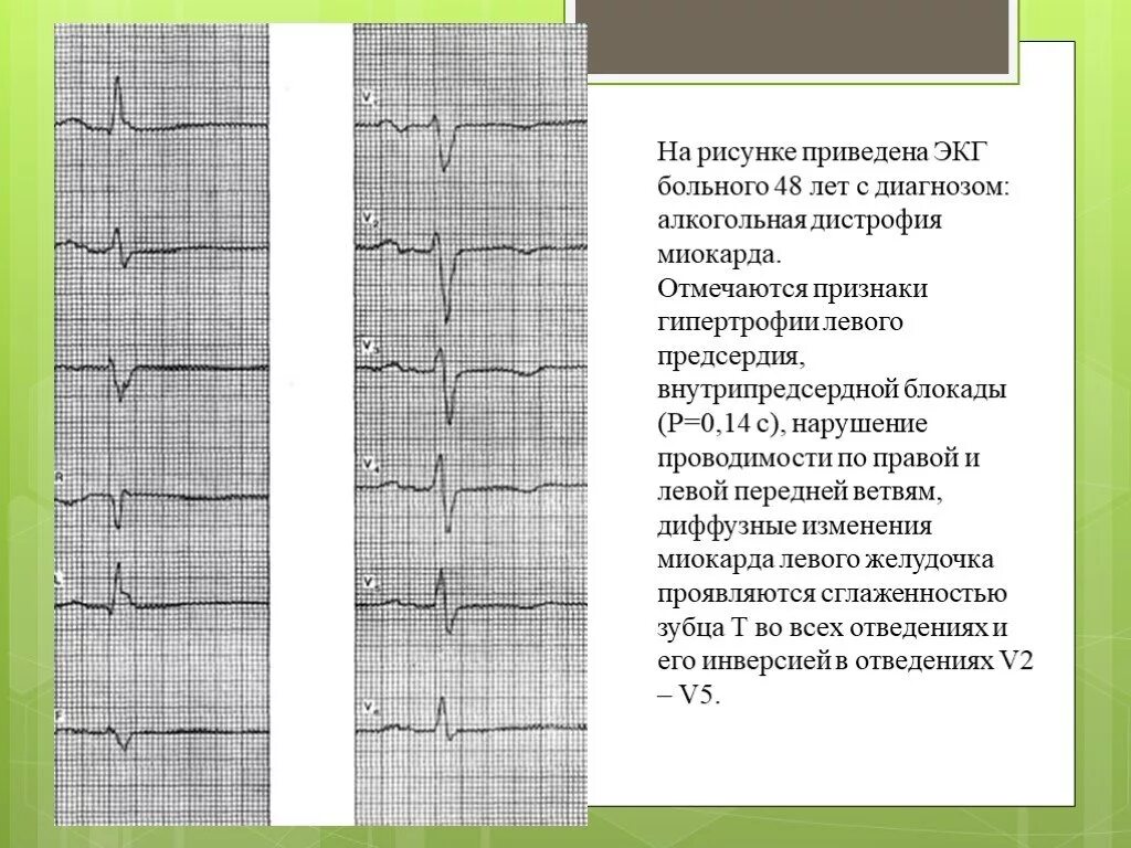 Диффузные изменения экг что это значит. Диффузное поражение миокарда ЭКГ. Дистрофия миокарда на ЭКГ. ЭКГ при диффузных изменениях миокарда. Метаболические изменения в миокарде на ЭКГ.