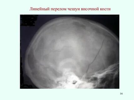 Переломы черепных ямок