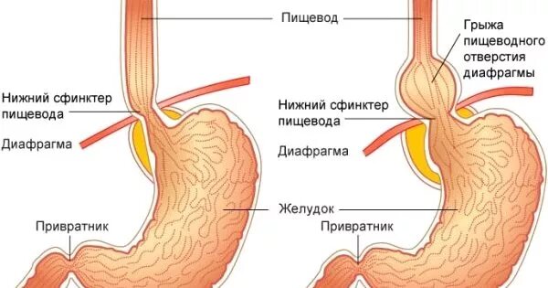 Грыжа пищевода признаки симптомы. Грыжа пищеводного отдела диафрагмы операция. Грыжа пищевого отверстия диафрагмы. Грыжа пищеводного отверстия диафрагмы гимнастика.