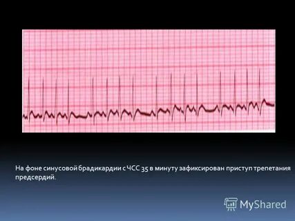 Синусовая брадикардия с чсс