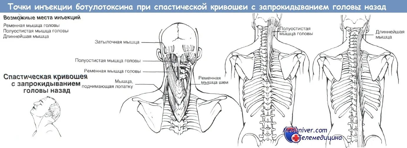 Ременная мышца головы. Кривошея длиннейшая мышца. Полуостистая мышца головы. Болит шея при запрокидывании головы назад. Точка уколова