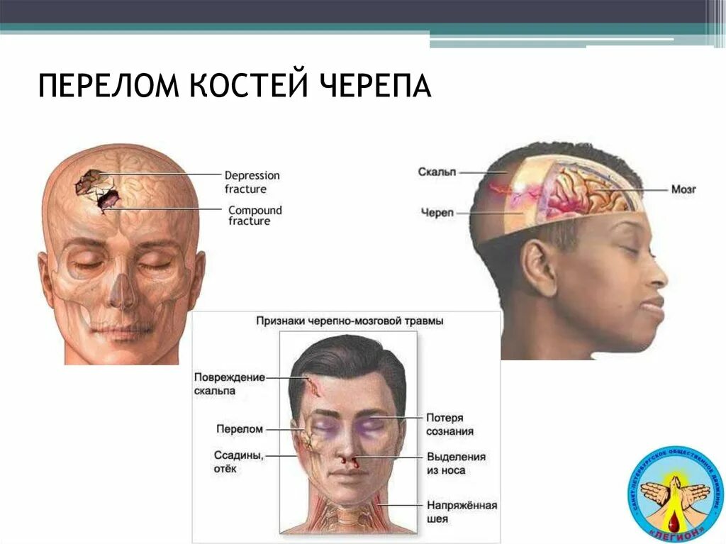 Трещина в голове. Перелом костей свода основания черепа симптомы. Симптомы повреждения костей черепа. Черепно мозговая травма с переломом костей черепа. Симптомы перелома костей основания черепа.