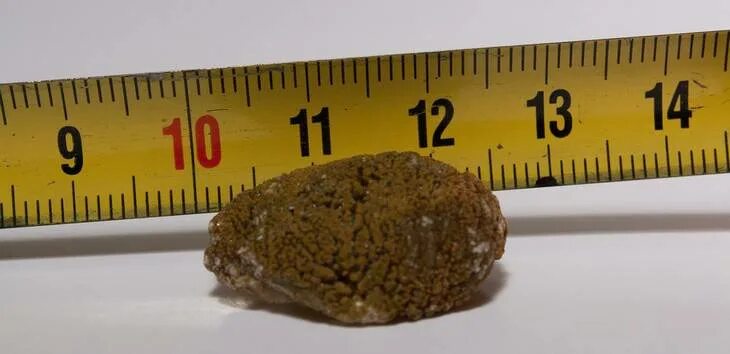 Два камня в почке. Мочекаменная болезнь камни в почках. Образование камней в почках. Уратный -фосфатный камень в почке. Уратные камни в мочеточнике.