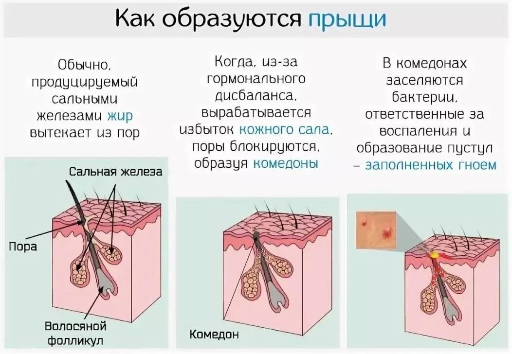 Прыщи где почему. Акне кожа схема сальные железы.