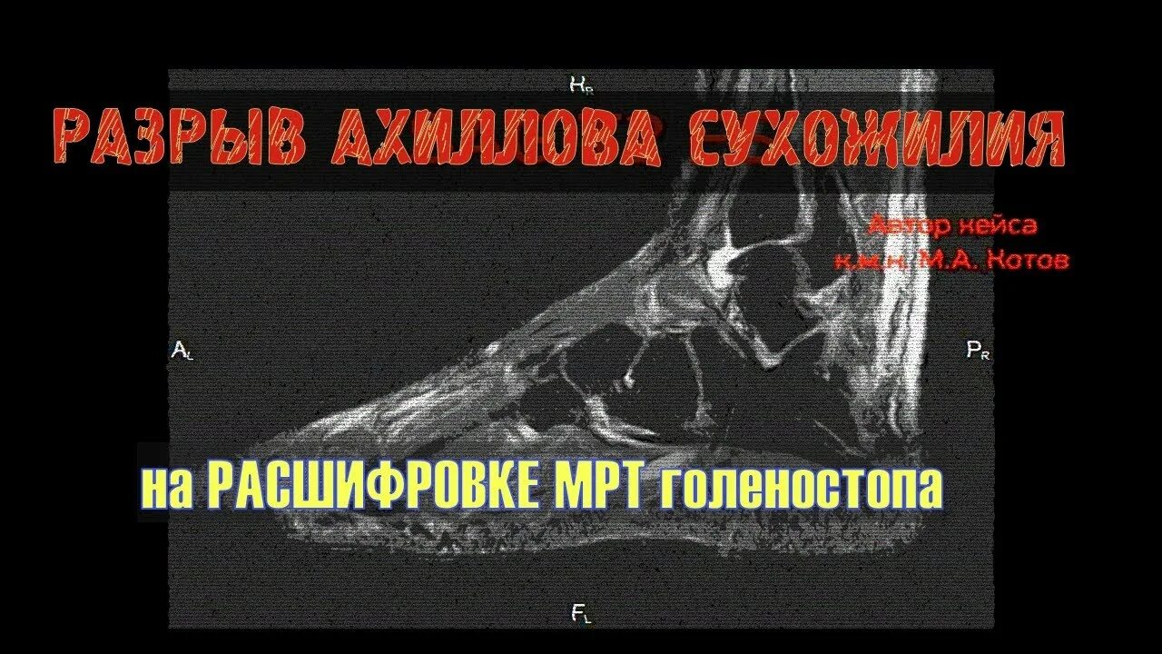 Мрт ахиллового сухожилия. Патология ахиллова сухожилия на мрт. тендинит ахиллова сухожилия рентген. разрыв ахиллова сухожилия мрт. полный разрыв ахиллова сухожилия мрт.
