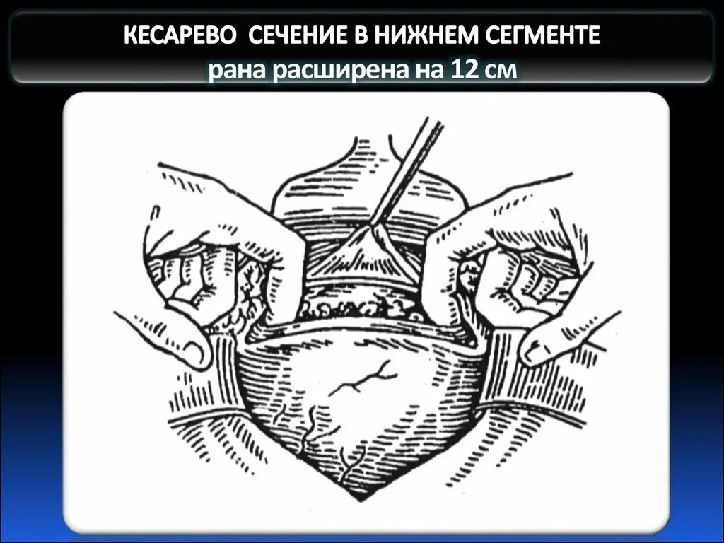 Кесарево сечение разрез операция. Корпоральное кесарево сечение. Разрез кесарева сечения. Малое кесарево сечение. Техника кесарева сечения