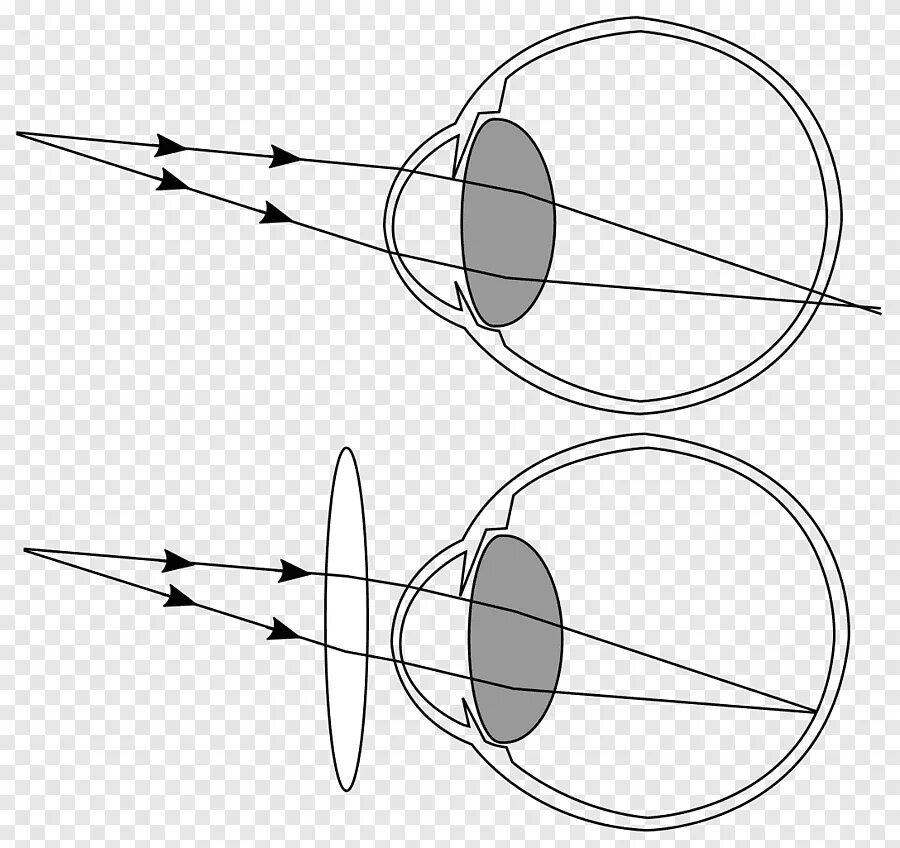 Дальнозоркость линзы двояковыпуклые. Дальнозоркость. Дальнозоркость рисунок. Дальнозоркость наглядно. Аметропия.