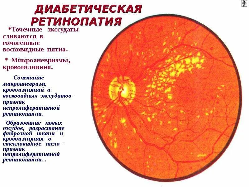 Сетчатки мкб. Ретинопатия непролиферативная стадия. Непролиферативная диабетическая ретинопатия глазное дно. Непролиферативная диабетическая ретинопатия патогенез. Пролиферативная диабетическая ретинопатия мкб