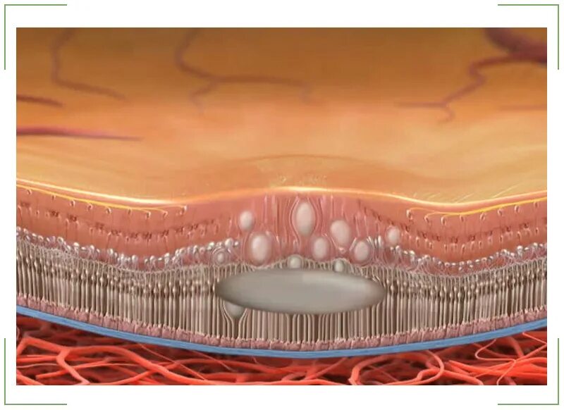 Центральная серозная хориоретинопатия. Центральная серозная хориоретинопатия глаза. Нейроэпителий сетчатки.