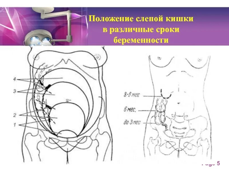 Аппендэктомия у беременных. Аппендицит у беременной. Аппендицит у беременных расположение. Червеобразный отросток у беременных. Острый аппендицит у беременных