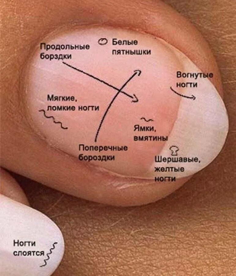 Что означают полосы на ногтях. Определить болезнь по ногтям. Заболевания по ногтям рук.