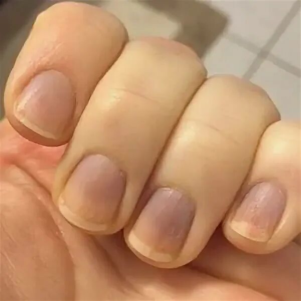 От чего синеют ногти