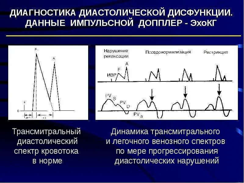 Ддлж по 1 типу по узи сердца. Узи сердца диастолическая дисфункция. типы нарушения диастолической функции лж. нарушение диастолической функции эхокг. оценка диастолической функции лж по эхокг.