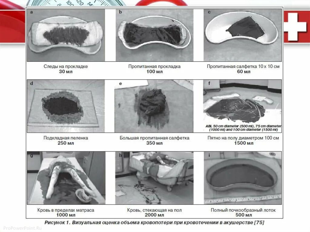 Сколько норма прокладок в день при месячных. Визуальная оценка объема кровопотери. Объем кровопотери при менструации. Визуальное руководство оценки объема кровопотери. Визуальный метод определения кровопотери в акушерстве.