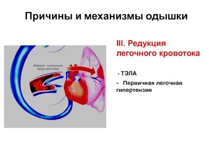 Нарушения легочного кровообращения